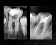 Endosealer Plus - Imagen 2
