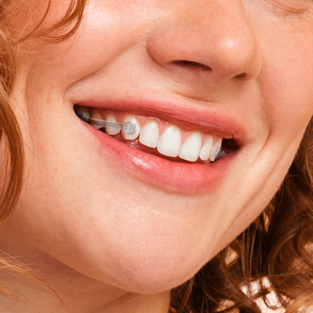 Corrector Clase II Iceram Distalizador (2 Unidades)